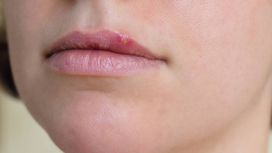 Lippenherpes - Fieberblase